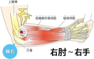 肘の痛み-300x190